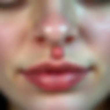 Acne on Upper Lip Close-up of a skin area showing acne on the upper lip