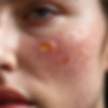 Close-up of inflamed skin showcasing acne lesions