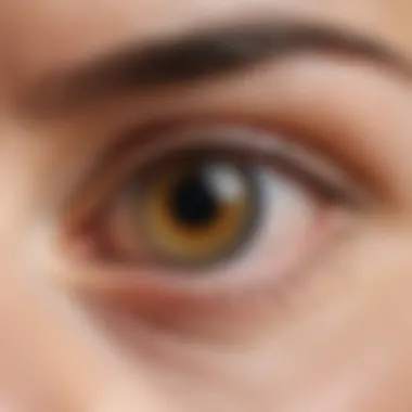 Illustration of a chalazion forming on the eyelid